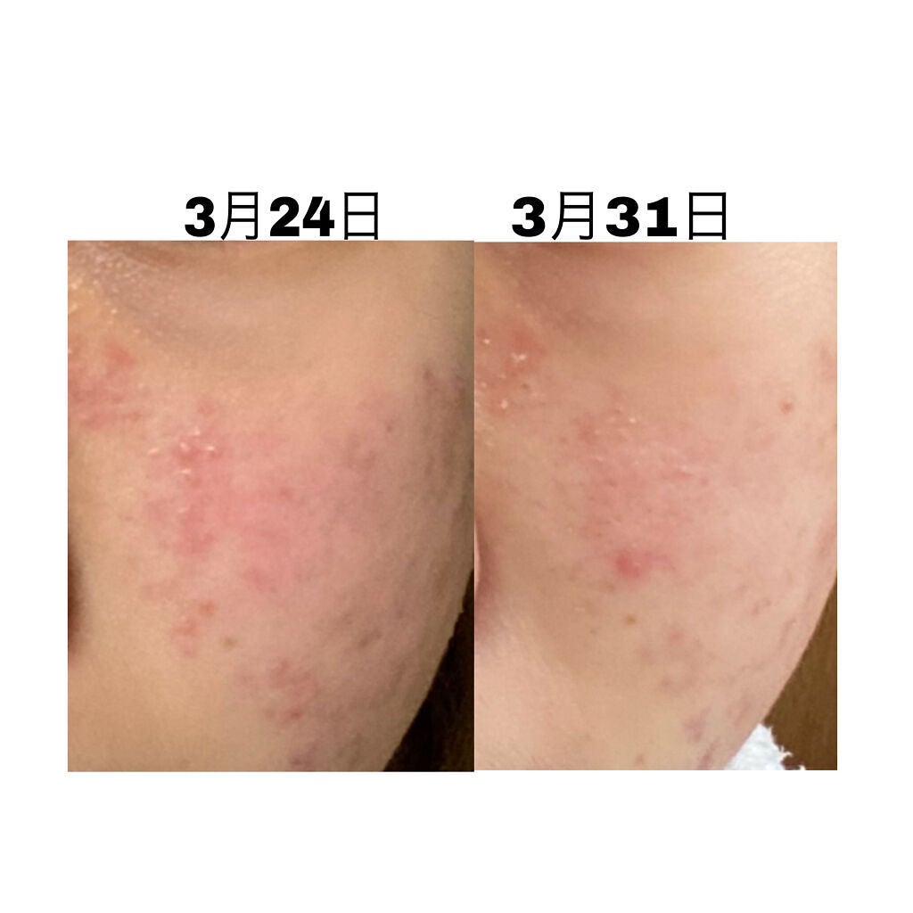 DHC ビタミンCハードカプセル/DHC/美容サプリメントを使ったクチコミ(4枚目)