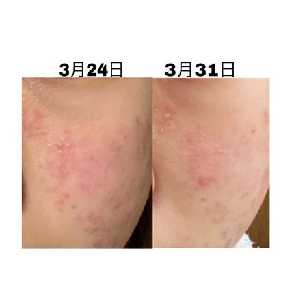 DHC ビタミンCハードカプセル/DHC/美容サプリメントを使ったクチコミ(4枚目)