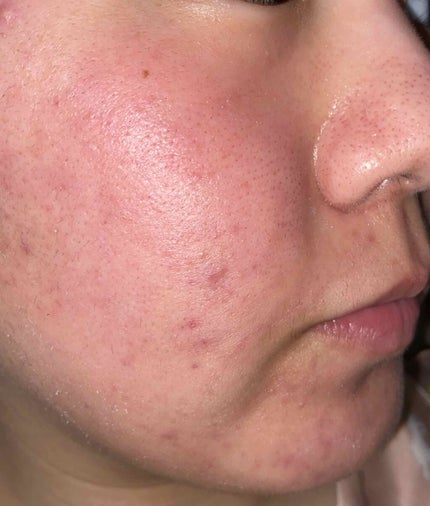 ベピオゲル/マルホ株式会社/その他を使ったクチコミ(2枚目)