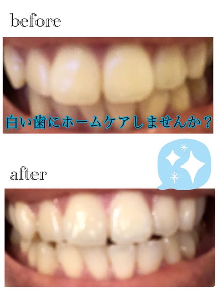ホワイトニングスタートキット/SHINE SMILE/その他オーラルケアを使ったクチコミ(1枚目)