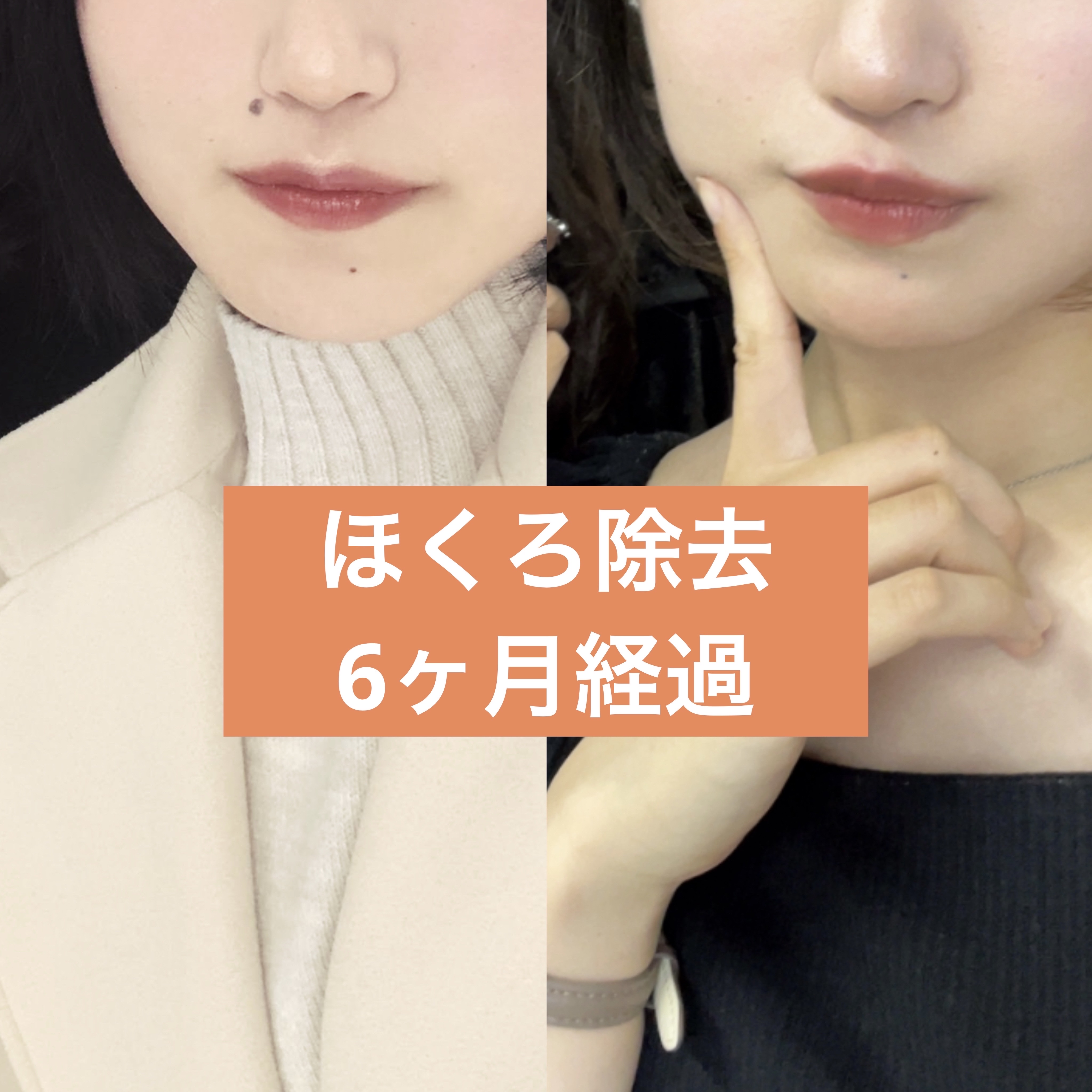 キズパワーパッド スポットタイプ/バンドエイド/その他を使ったクチコミ（1枚目）