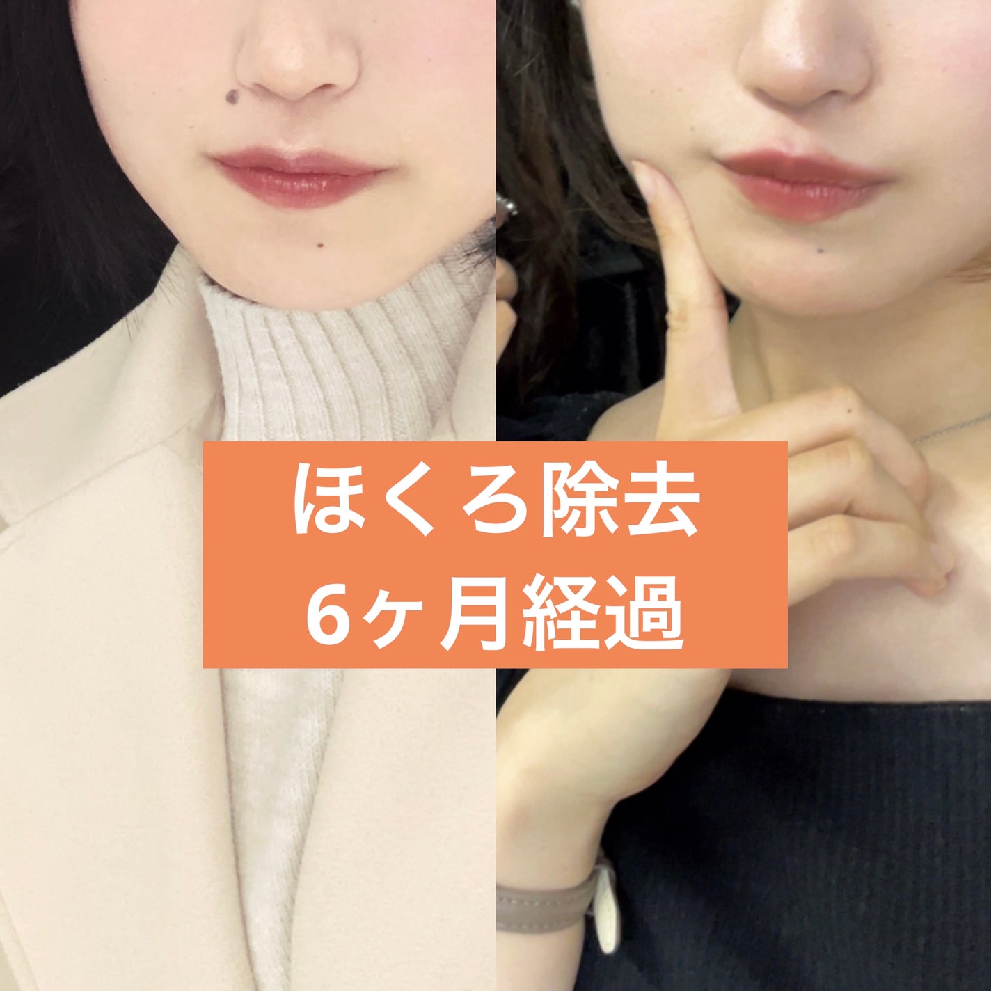 キズパワーパッド/バンドエイド/その他を使ったクチコミ(1枚目)