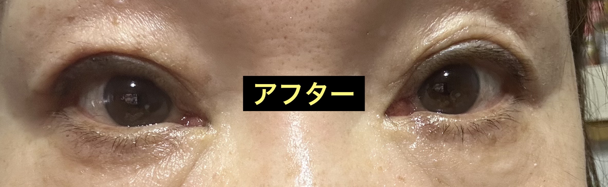 TWOOL ダブルアイリッドグルー ダブルアイリッドグルー 接着タイプ/SHOBIDO/二重まぶた用アイテムを使ったクチコミ（3枚目）