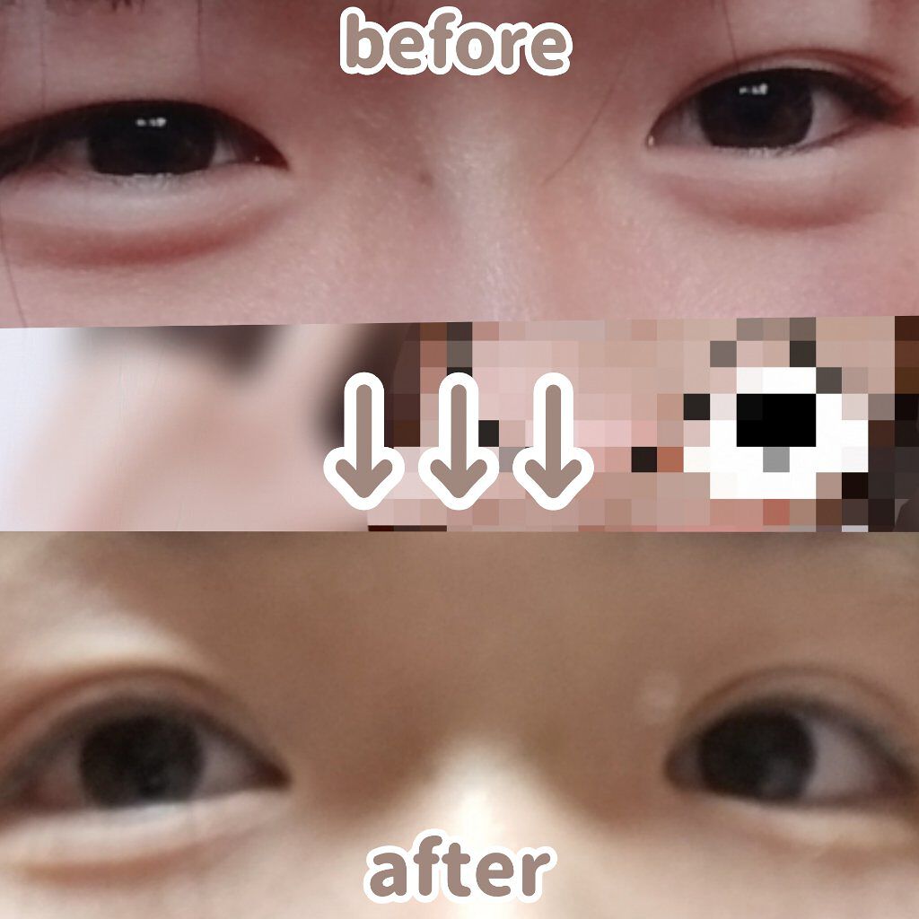 ダブルアイリッド/DAISO/二重まぶた用アイテムを使ったクチコミ（2枚目）