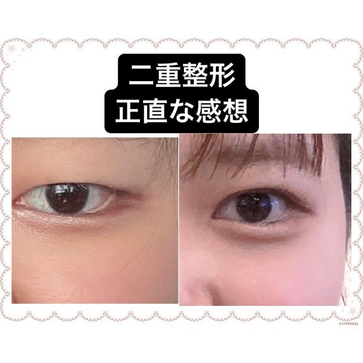 るり フォロリム🔙100 on LIPS 「まぶたの脂肪が重く脂肪吸引をして2点止めするか、線止めするかで..」(1枚目)