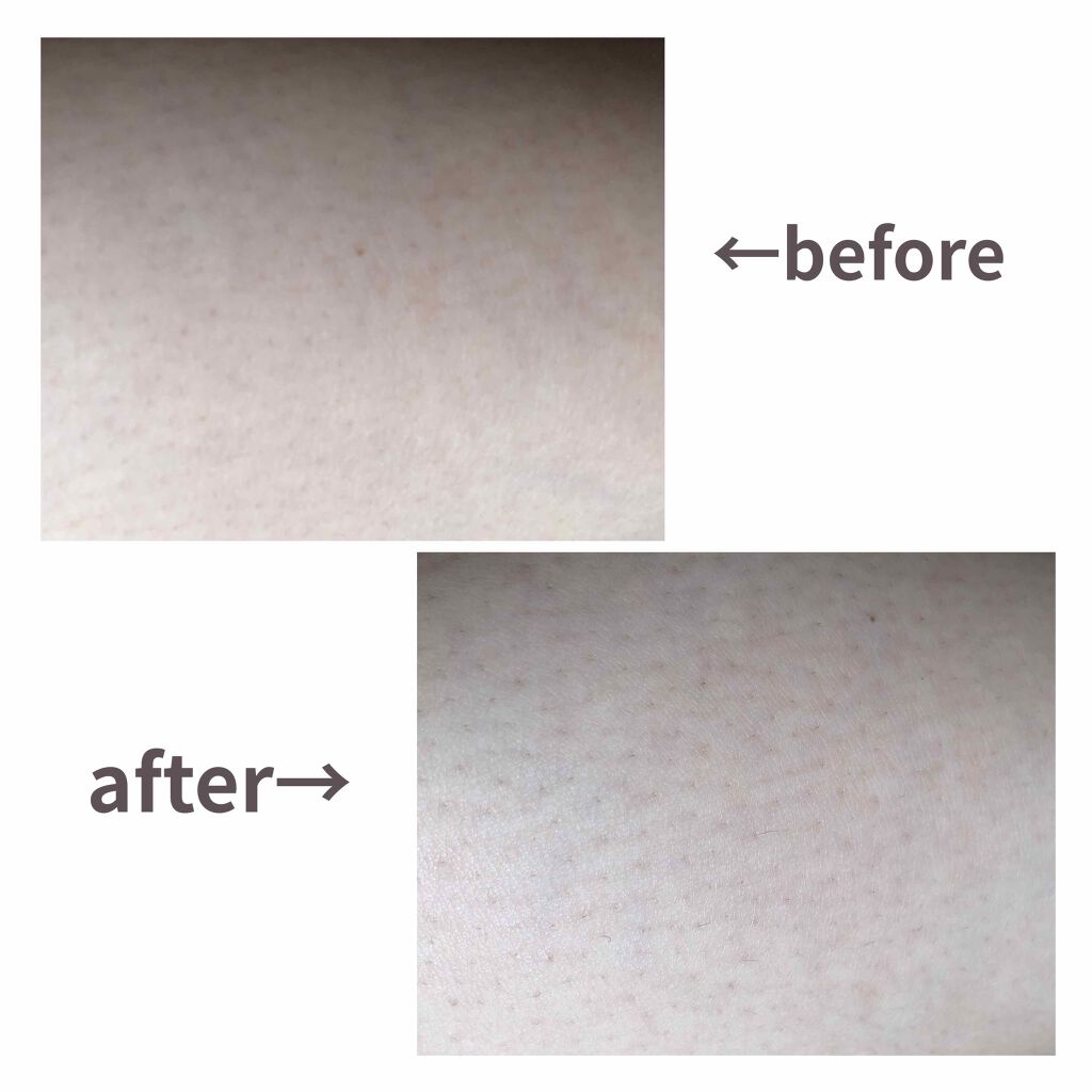 beyda IPL光脱毛器/beyda/家庭用脱毛器を使ったクチコミ(3枚目)