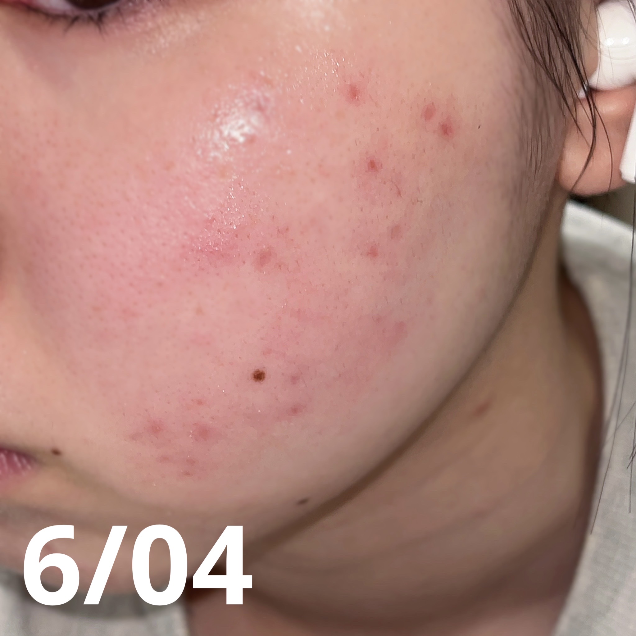 マジックティーツリーオイル/ブラン/フェイスオイルを使ったクチコミ（2枚目）