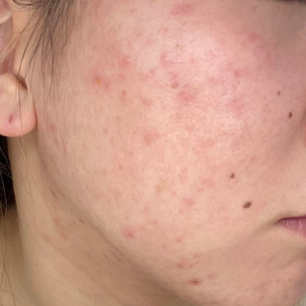 ぺんぎん on LIPS 「⚠️閲覧注意⚠️最近は新しいニキビができるのは減ってきました!..」(1枚目)