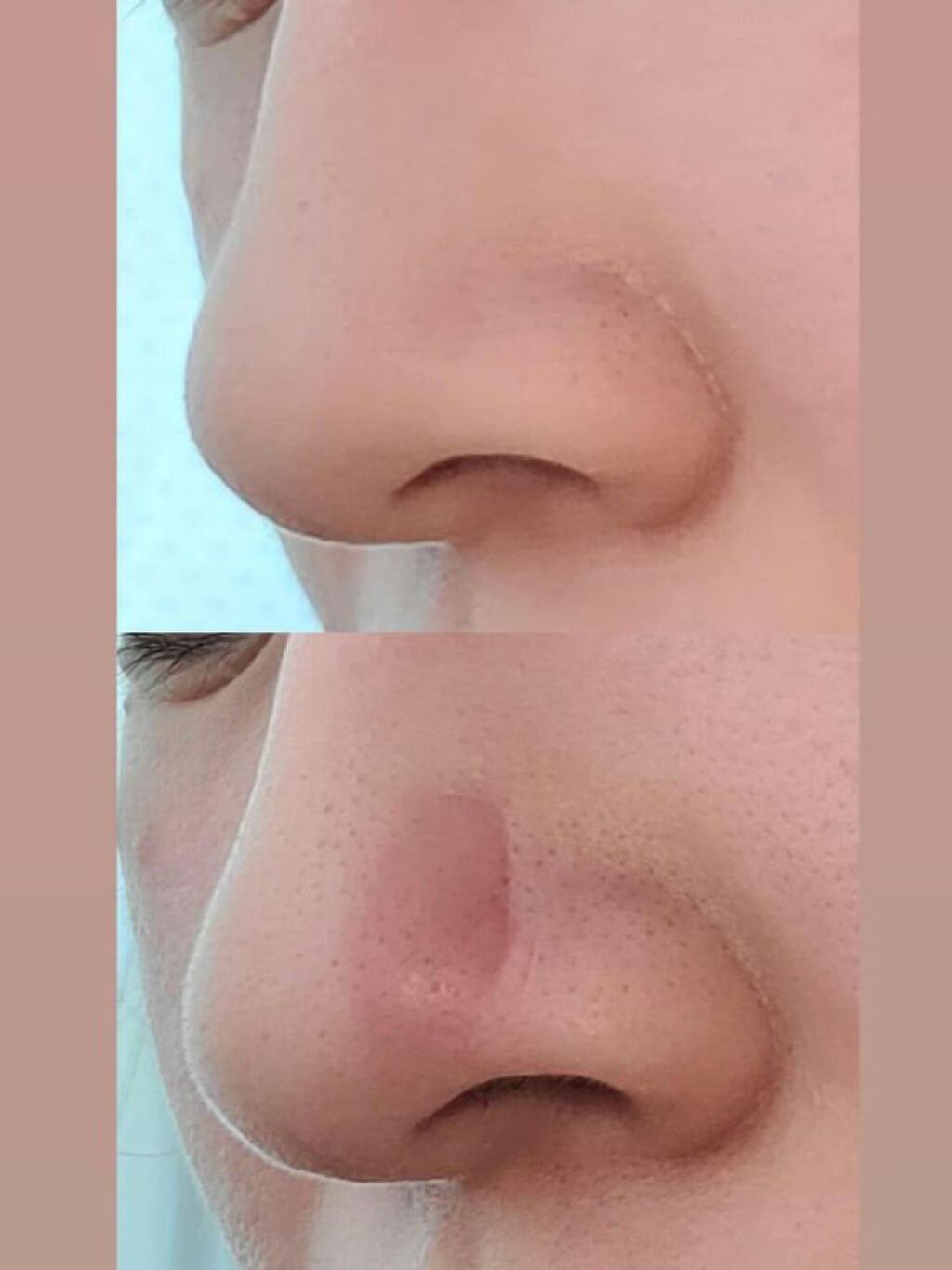 お鼻リフォーマー ハナハナ/グッズマン/その他を使ったクチコミ（3枚目）