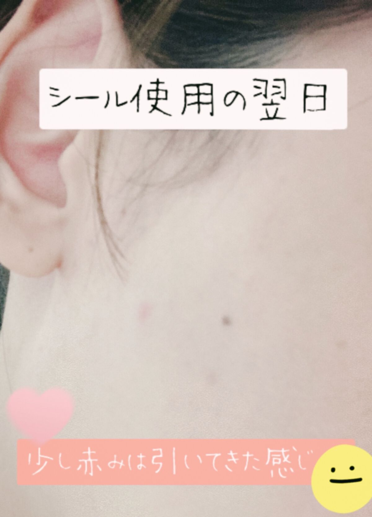 プロCICA クリアスポットパッチ/VT/その他スキンケアを使ったクチコミ(5枚目)