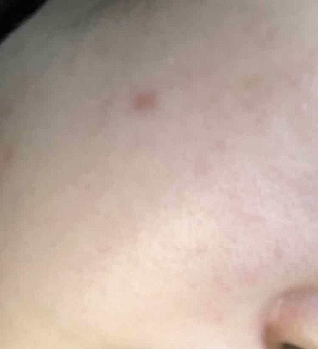 セラミドスキンケア 薬用アクネVCクリームジェル/エトヴォス/フェイスクリームを使ったクチコミ(3枚目)