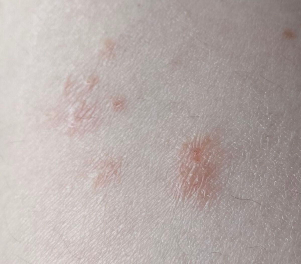 アットノンEX ジェル(医薬品)/アットノン/その他を使ったクチコミ(2枚目)