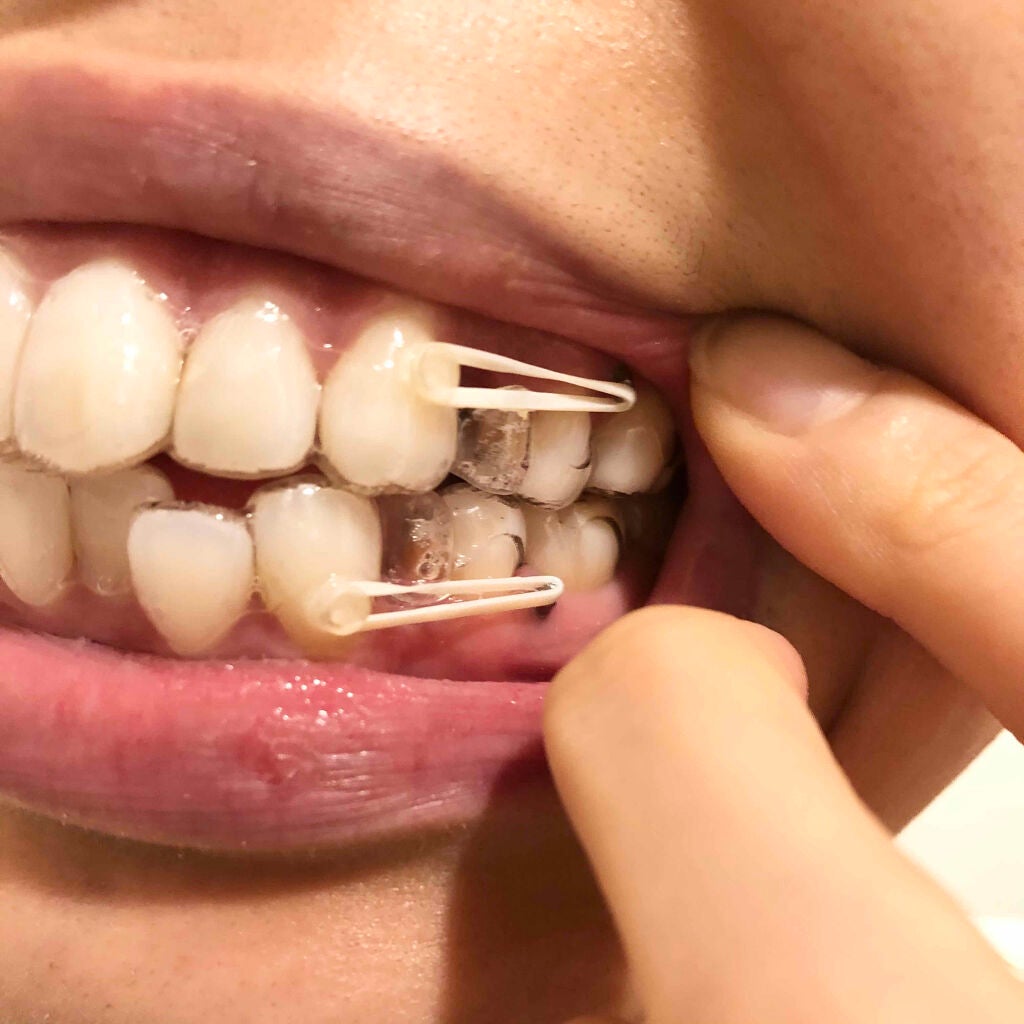 おたむ@フォロバ99 on LIPS 「【グロ注意⚠️】抜歯後の写メあり画像2枚目から抜歯した後の写メ..」(7枚目)