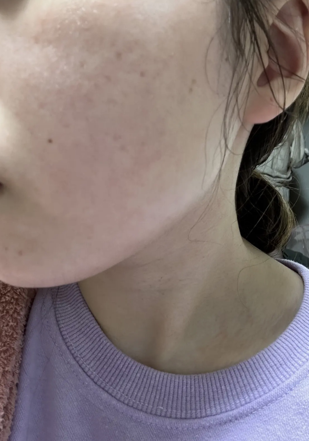 エファクラ ピールケア セラム/ラ ロッシュ ポゼ/美容液を使ったクチコミ（3枚目）