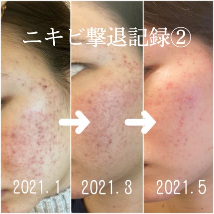 ハトムギ化粧水(ナチュリエ スキンコンディショナー R )/ナチュリエ/化粧水を使ったクチコミ(1枚目)