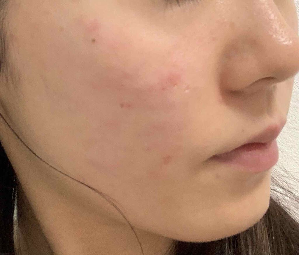 薬用 しみ 集中対策 美容液/メラノCC/美容液を使ったクチコミ（2枚目）