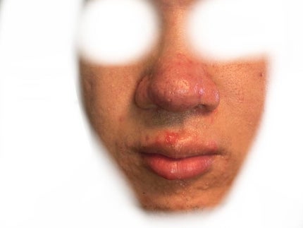 (フォロバ)3年後に韓国美男子 on LIPS 「CICA×HYALONフェスパック最終レビュー1ヶ月の経過写真..」(5枚目)