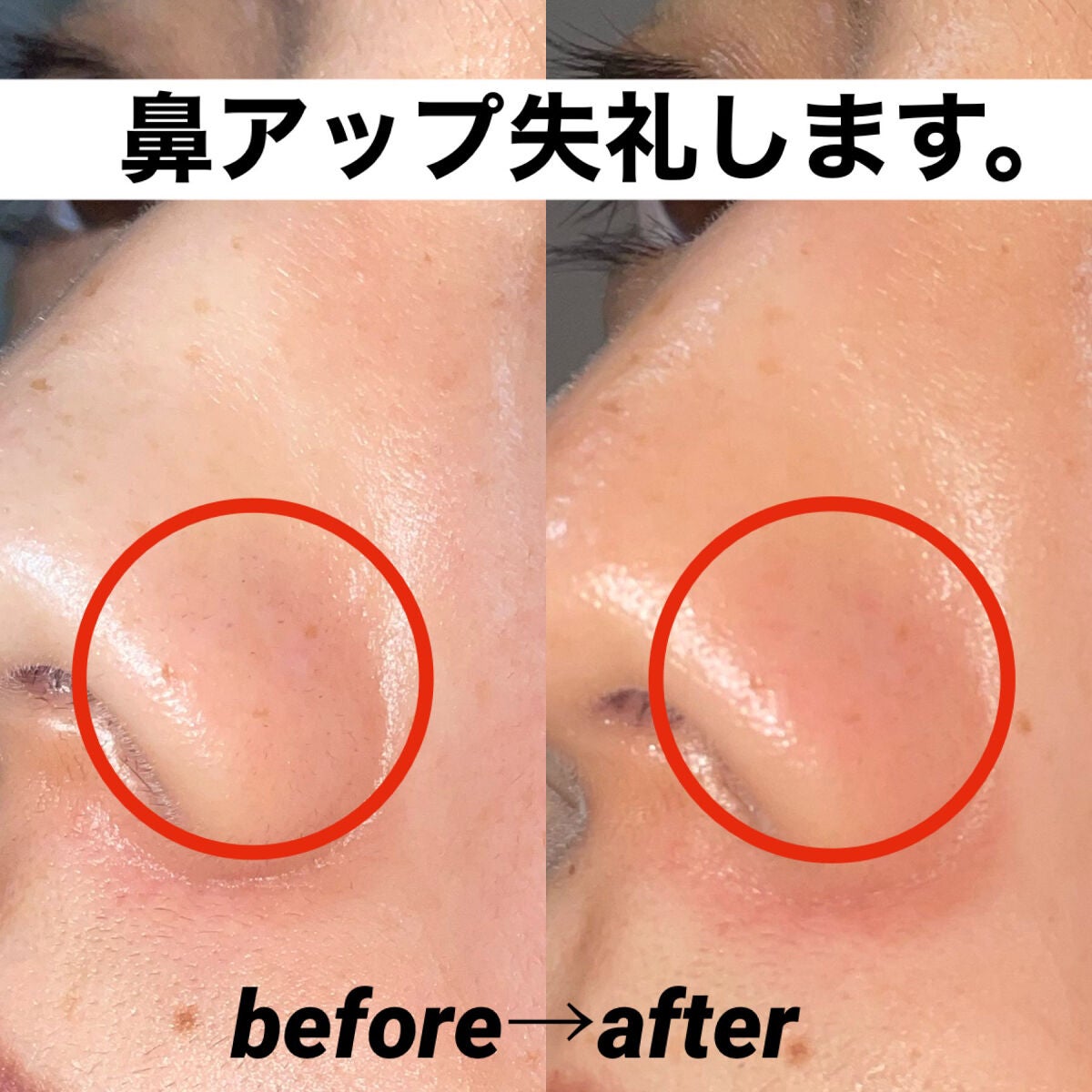 アクレオンセボエクストラクター/ANACIS/その他スキンケアを使ったクチコミ(5枚目)