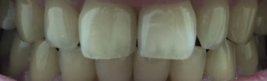 クレスト3Dホワイトニング ホワイトストリップ プロフェッショナル エフェクツ/クレスト/その他オーラルケアを使ったクチコミ（1枚目）