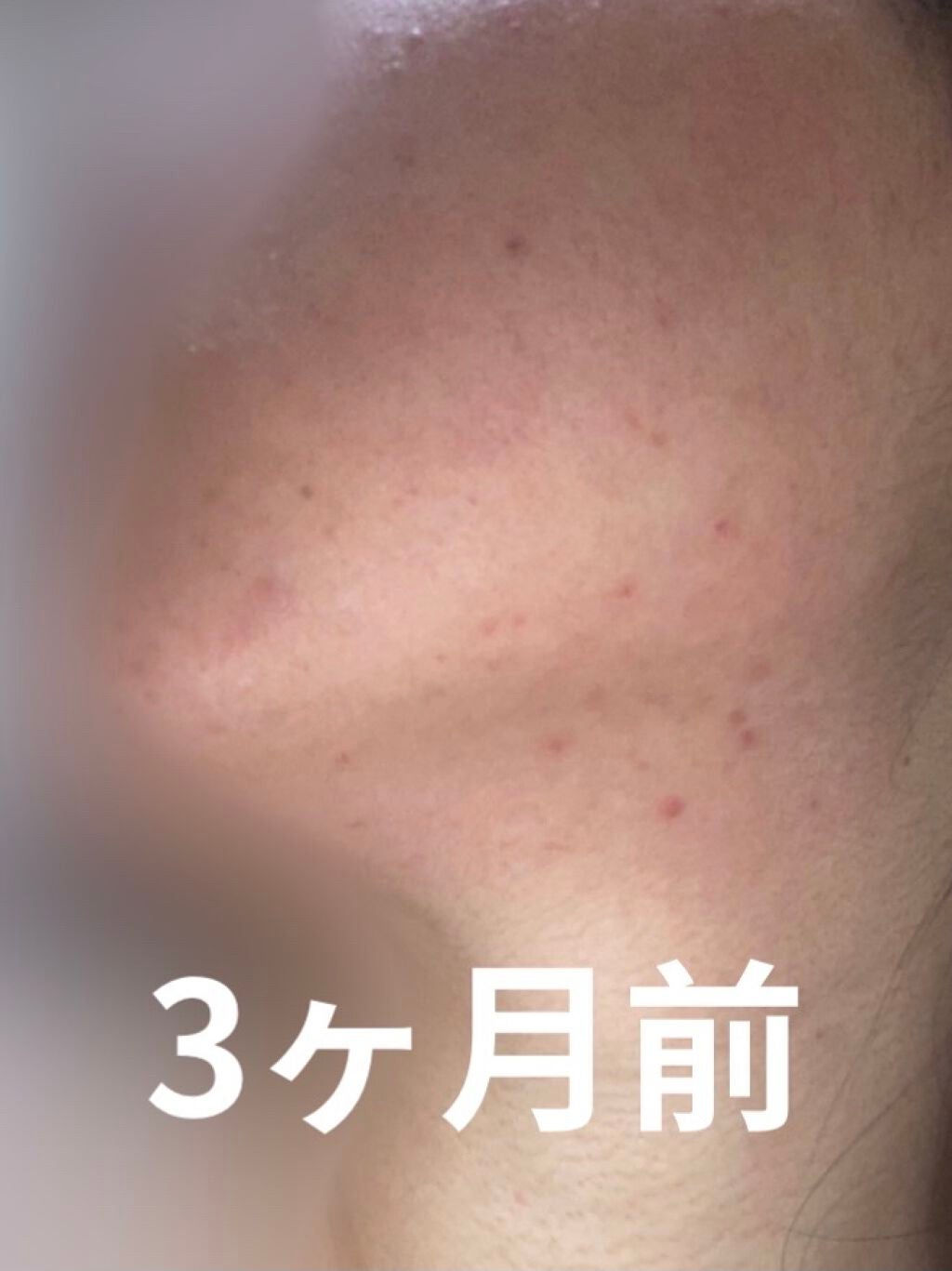 プレミア敏感肌用 Lディスポ/シック/シェーバーを使ったクチコミ(2枚目)