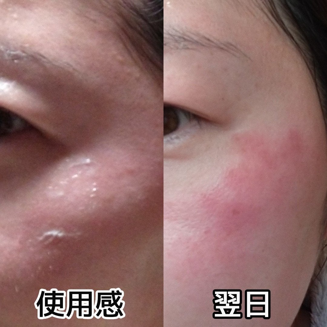 ヨナ フォロバ100 on LIPS 「MARKAIDハイドスピキュールクリーム15g使用して4日経ち..」(2枚目)