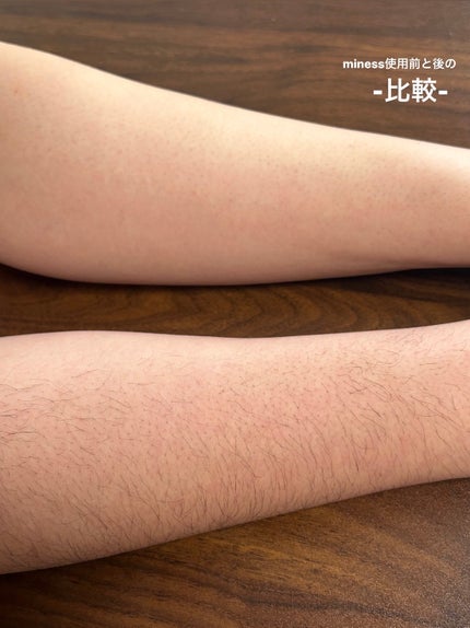 miness うで・あし用カミソリ/貝印/シェーバーを使ったクチコミ(5枚目)