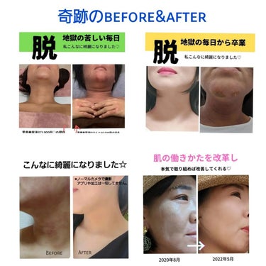 美肌カウンセラー💆綺麗のお助け相談所 on LIPS 「【私のBefore→After🧙‍♀️】アトピーって絶対に治る..」（1枚目）