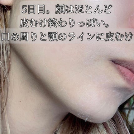 ダーマスキンピーリング/BQCELL/その他キットセットを使ったクチコミ(8枚目)