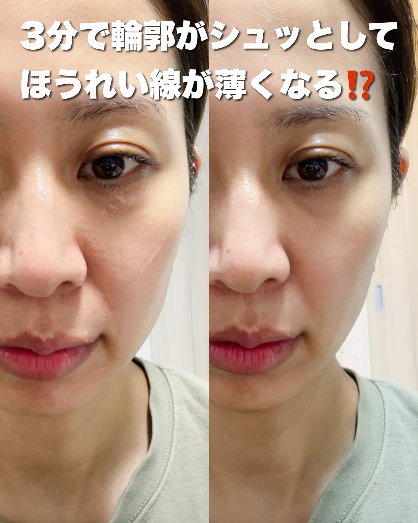 RF温冷美顔器PRO/ANLAN/美顔器・マッサージを使ったクチコミ(1枚目)