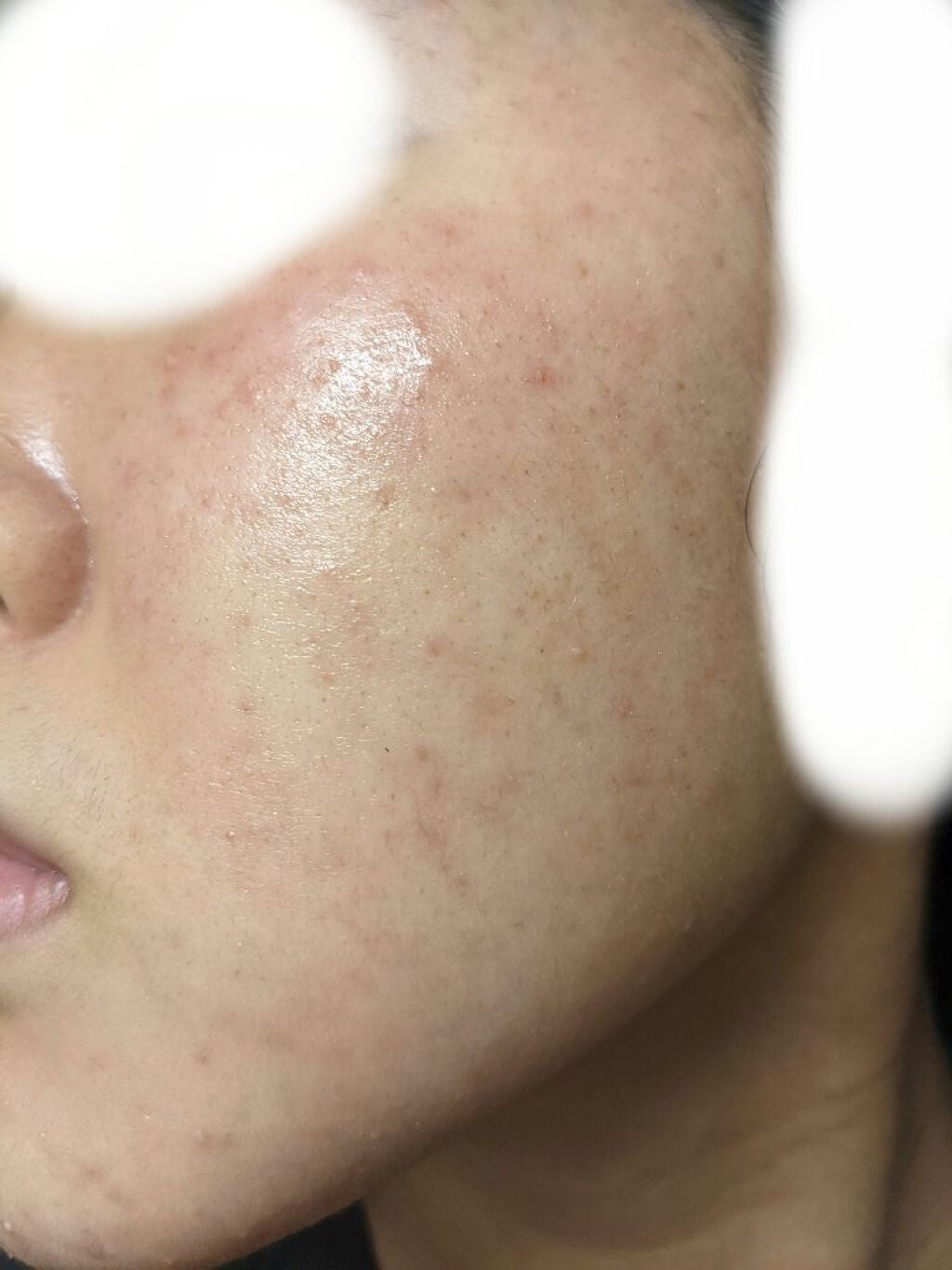 いやりんぐ on LIPS 「皮膚科の薬副反応が出るかもって聞いて少し怖かったんですけど、少..」(2枚目)