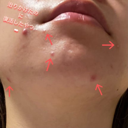 ティーツリーバイオーム ブレミッシュシカアンプル/MEDIHEAL/美容液を使ったクチコミ(2枚目)