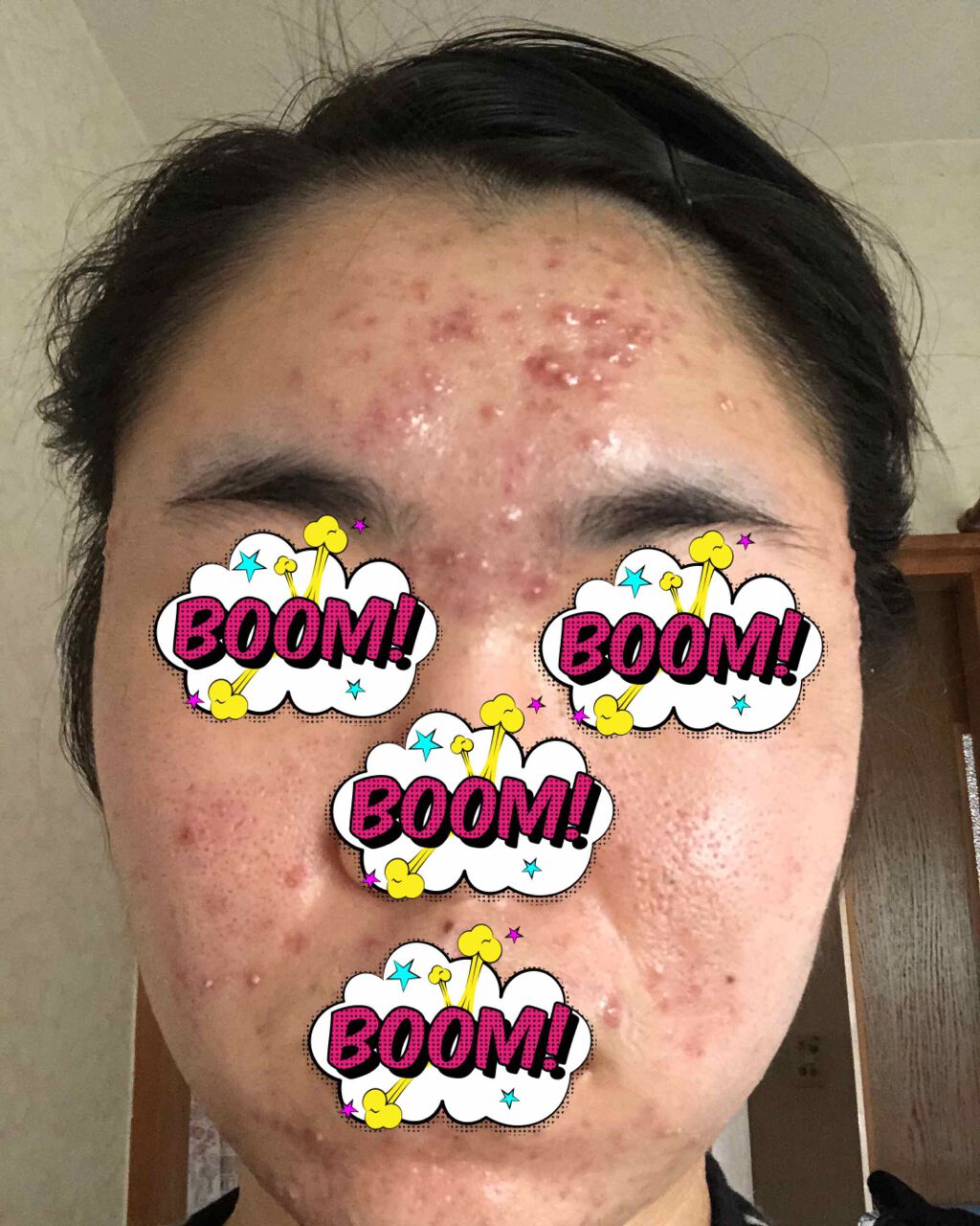 ダラシンTゲル 1% (医薬品)/佐藤製薬/その他を使ったクチコミ（2枚目）