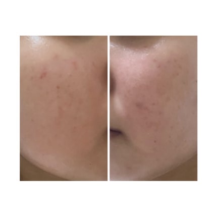 ぽむ on LIPS 「2023.9.13皮膚科に受診 エピデュオとヘパリン処方1枚目..」(4枚目)