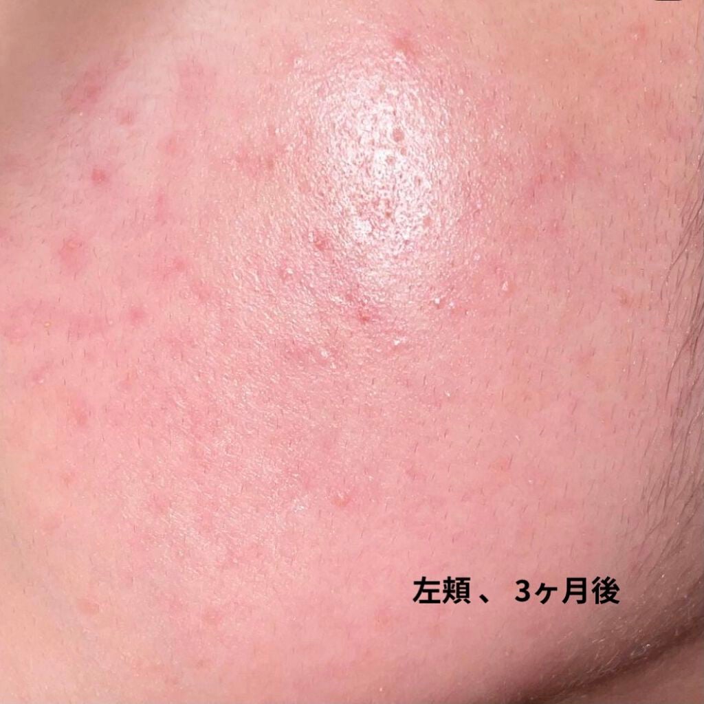 けろけろけろっぴ on LIPS 「こんにちは!けろけろけろっぴです(*`・ω・*)ゞ今日は思春期..」(5枚目)