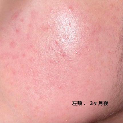 けろけろけろっぴ on LIPS 「こんにちは!けろけろけろっぴです(*`・ω・*)ゞ今日は思春期..」(5枚目)