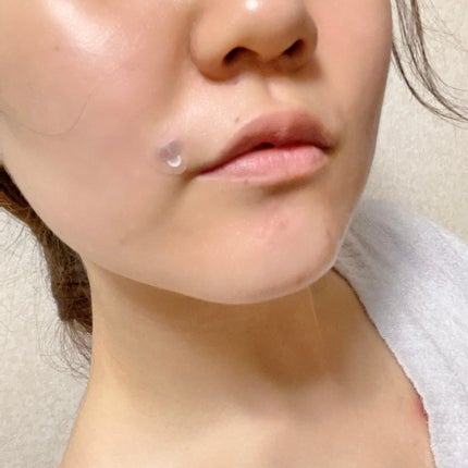 ACマグネシウムパッチ ミニ/スノーツープラス/にきびパッチを使ったクチコミ(7枚目)