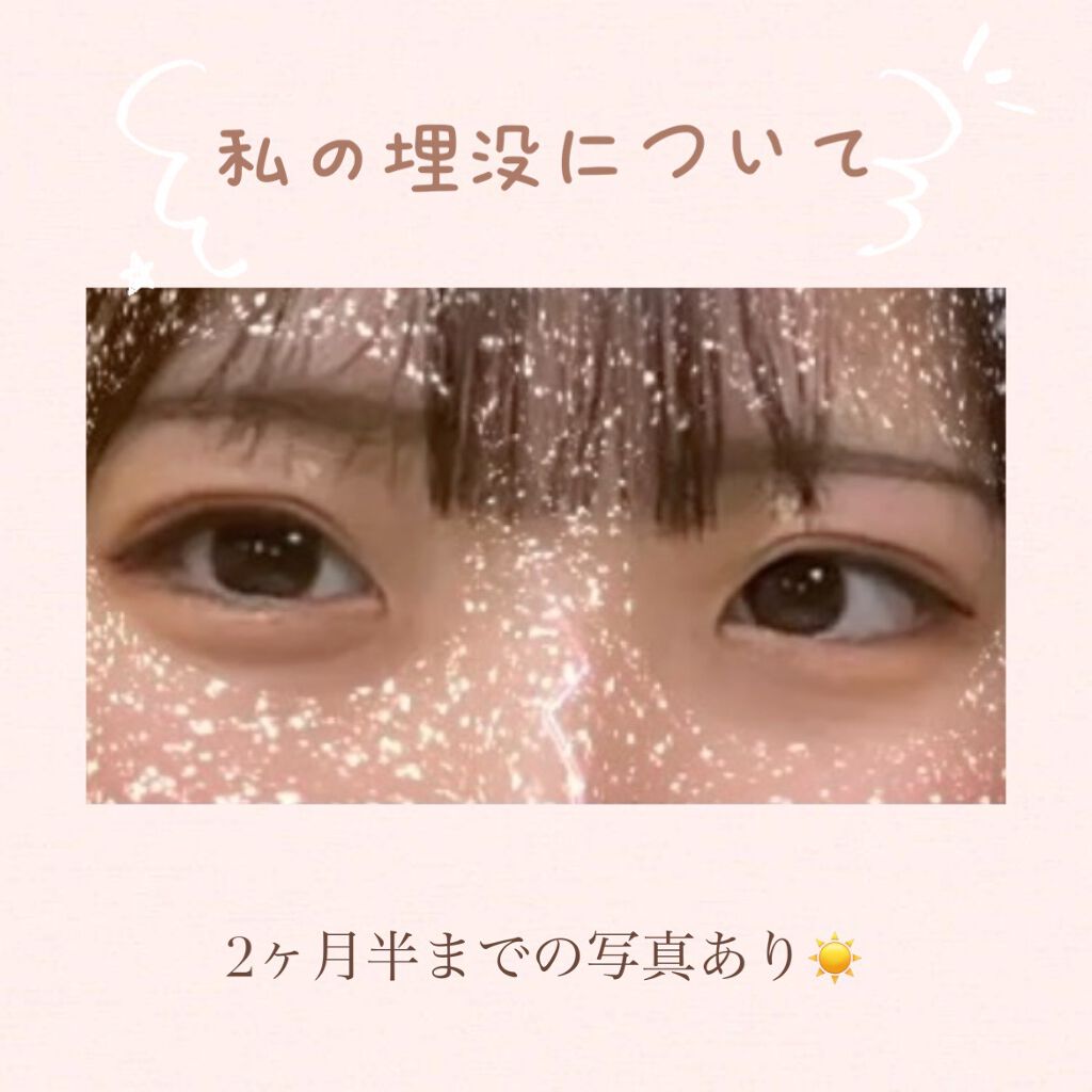 うめぼし on LIPS 「埋没から2ヶ月半経過!!更新おそくてごめんなさい🙏前回の投稿で..」(1枚目)