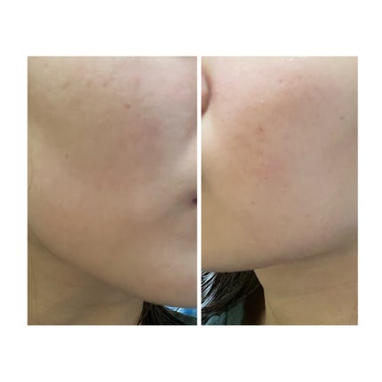 ぽむ on LIPS 「2023.9.13皮膚科に受診 エピデュオとヘパリン処方1枚目..」(2枚目)