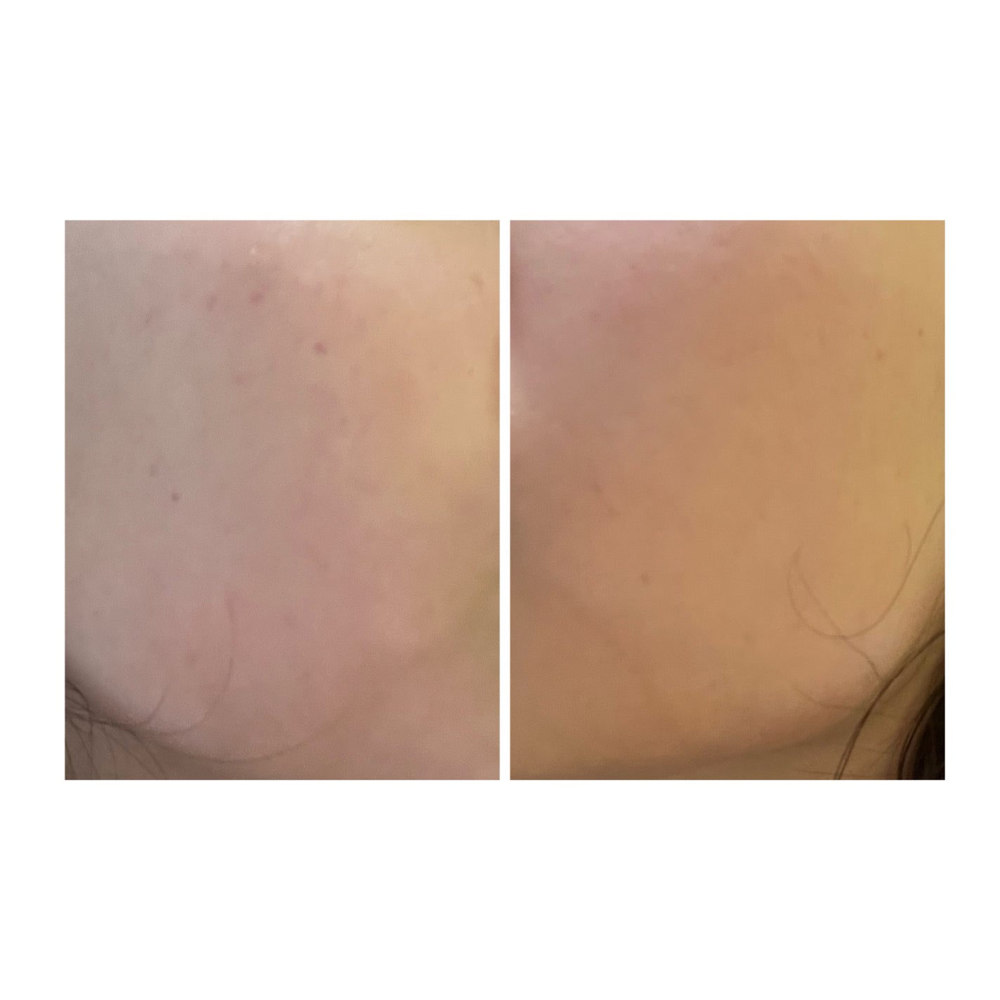 ぽむ on LIPS 「2023.9.13皮膚科に受診 エピデュオとヘパリン処方1枚目..」(5枚目)