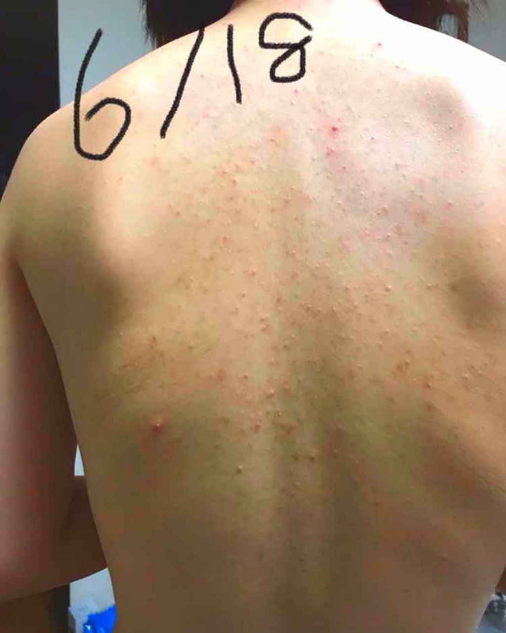 ニキビを防ぐ薬用石鹸 ForBack/ペリカン石鹸/ボディ石鹸を使ったクチコミ(2枚目)