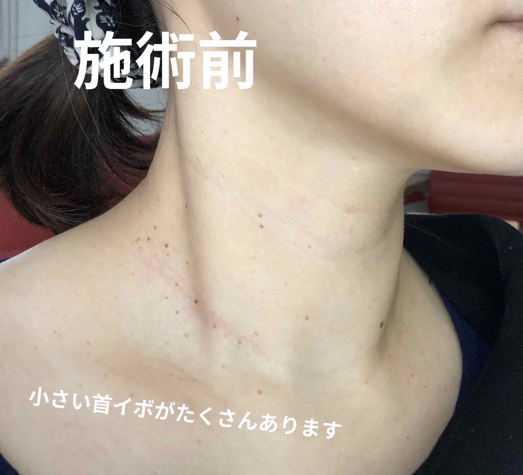 くろみ on LIPS 「⚠️症例写真あります⚠️苦手な方はご注意下さい⚠️30代を迎え..」(2枚目)