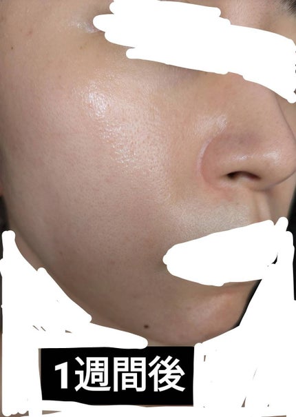 れれ on LIPS 「前情報:顔脱毛は1回しかまだ完了してません品川美容皮膚科でフラ..」(5枚目)