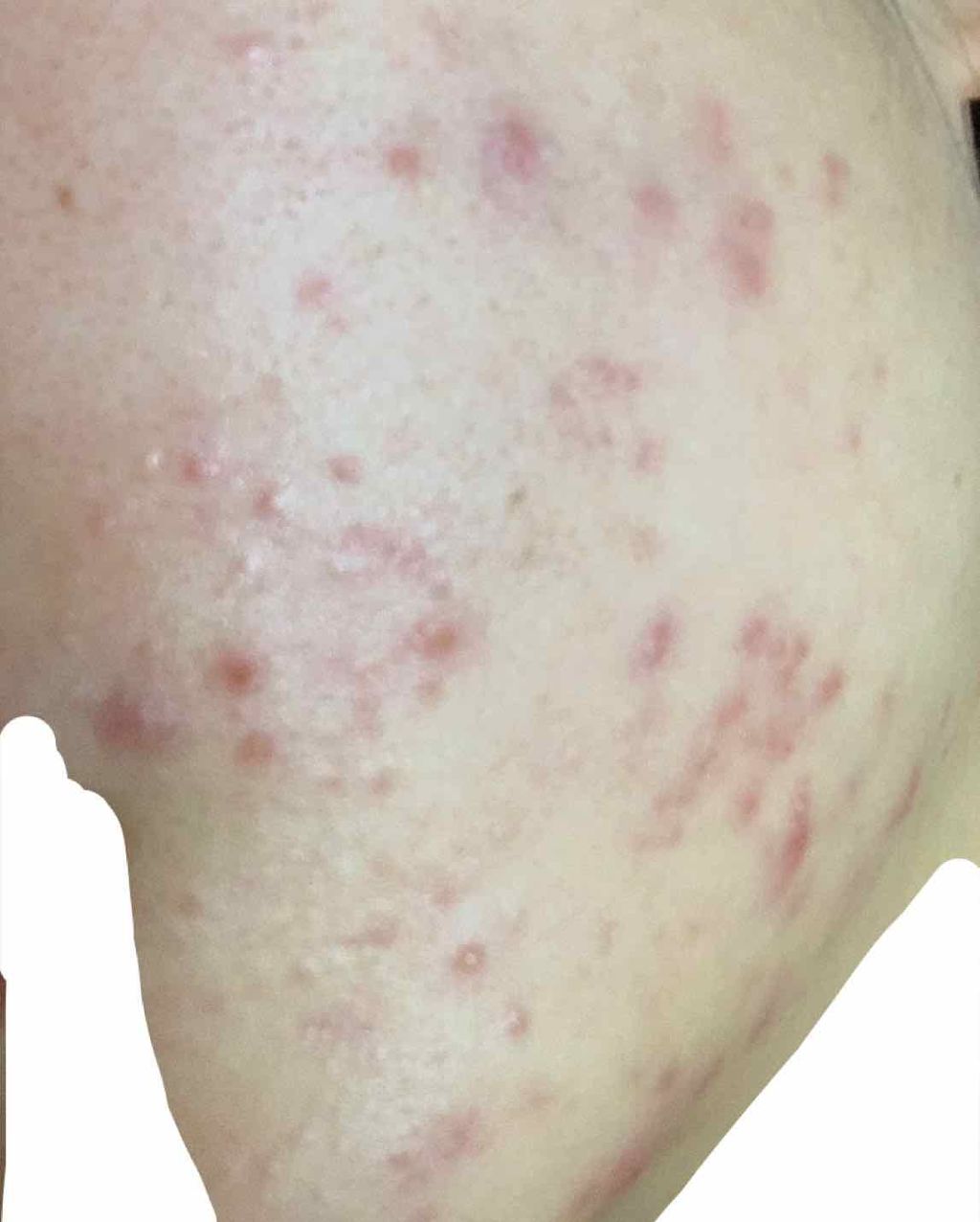 ペアアクネクリームW(医薬品)/ペア/その他を使ったクチコミ（3枚目）