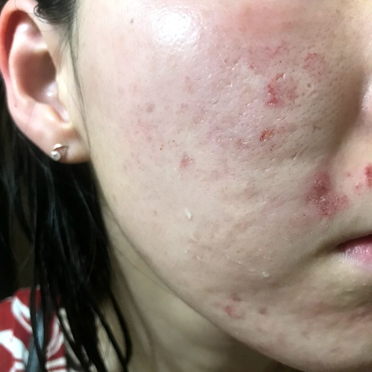 miina@汚肌工事録⚠️ on LIPS 「8/5㈮よるの#汚肌工事録💡皮膚科発の #美容皮膚科 にてデル..」(2枚目)