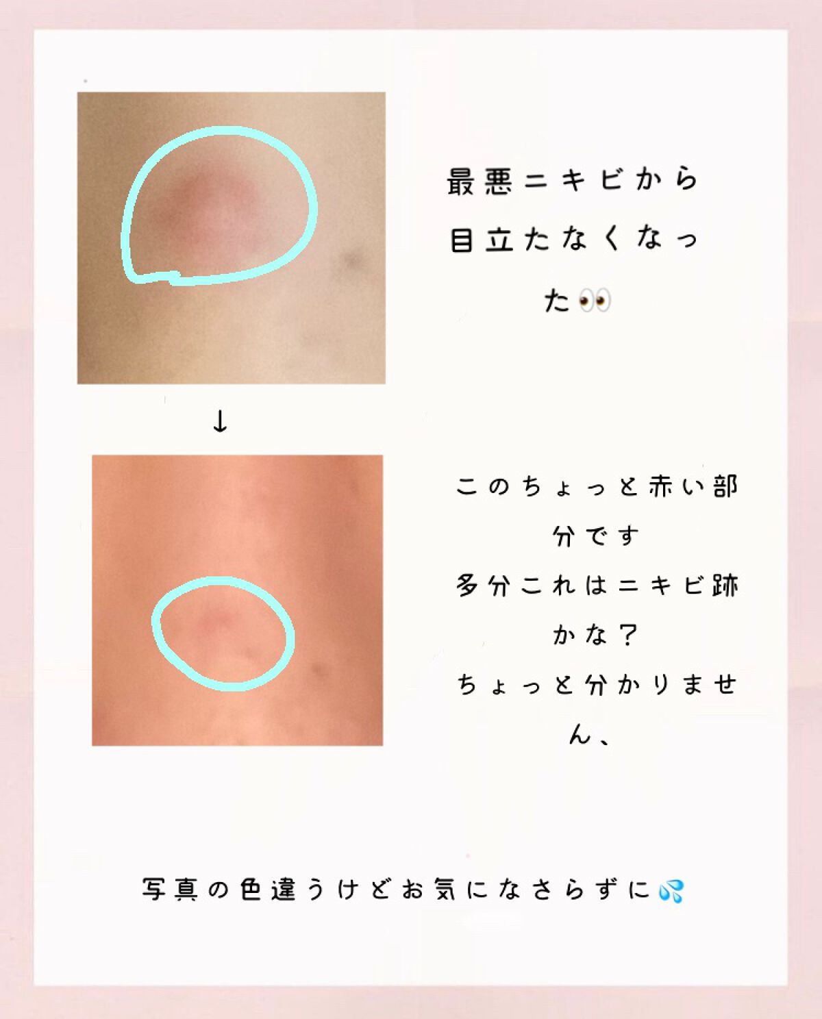 プロCICA クリアスポットパッチ/VT/その他スキンケアを使ったクチコミ（2枚目）