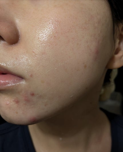 miina@汚肌工事録⚠️ on LIPS 「11/15の#汚肌工事録..」(2枚目)