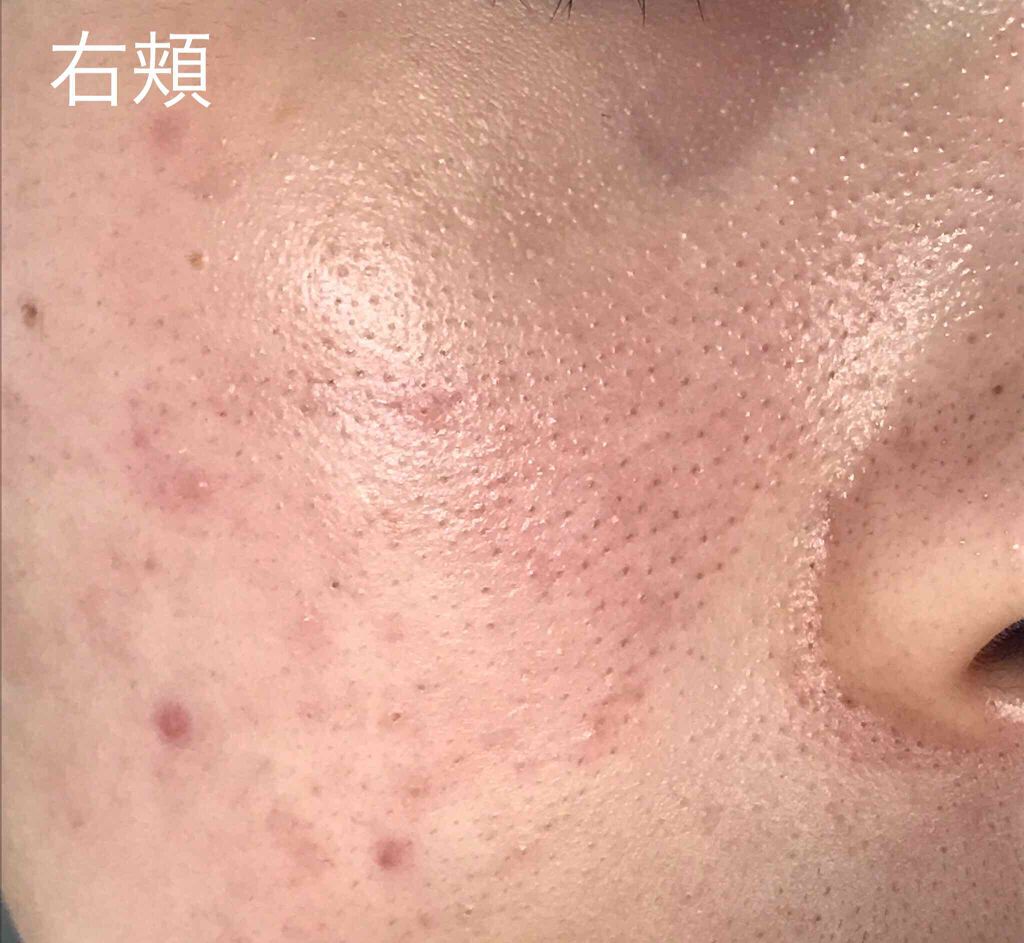 ペアアクネクリームW(医薬品)/ペア/その他を使ったクチコミ(2枚目)