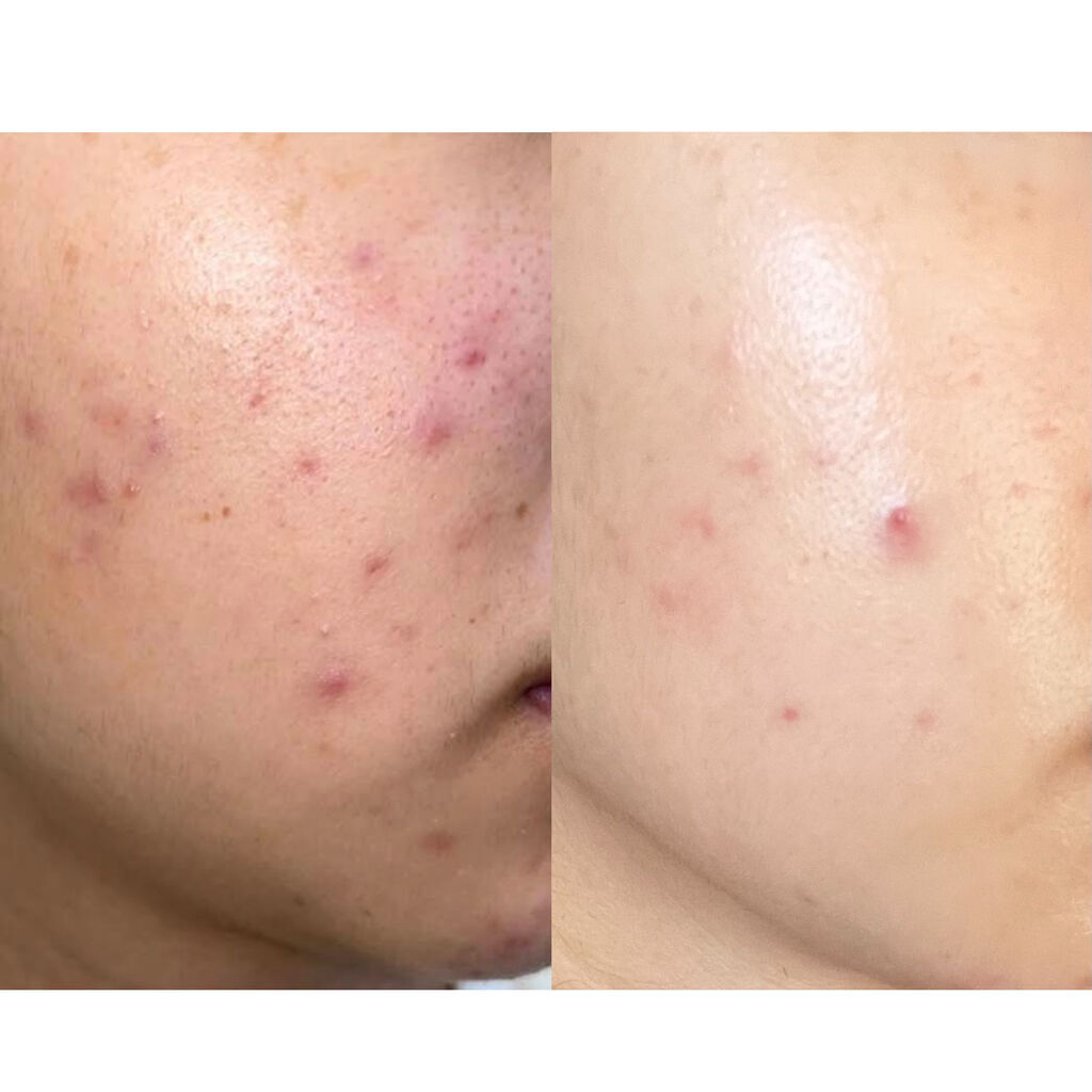 潤浸保湿 化粧水 III とてもしっとり/キュレル/化粧水を使ったクチコミ（2枚目）