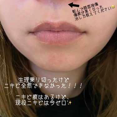 AHA 30% + BHA 2% Peeling Solution/The Ordinary/ピーリングを使ったクチコミ（2枚目）