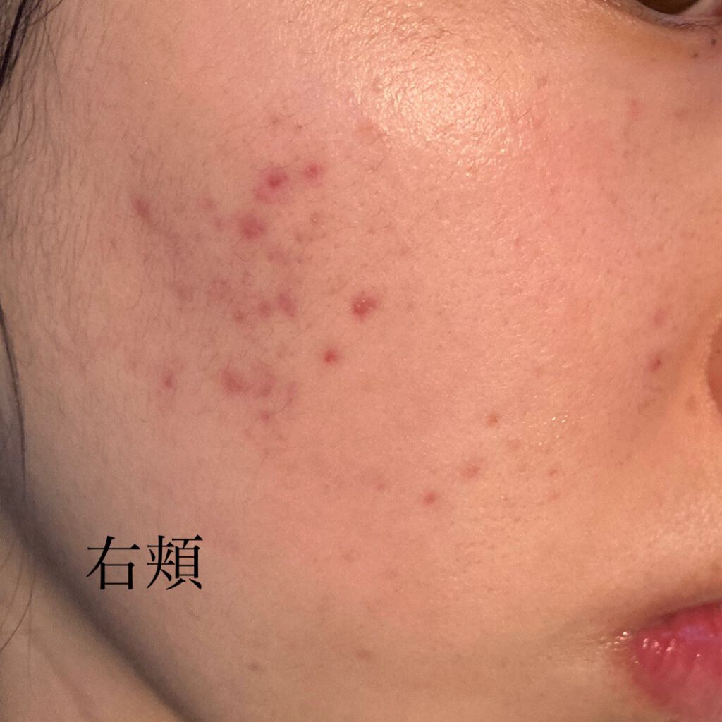 アクネケアローション W/d プログラム/化粧水を使ったクチコミ(3枚目)